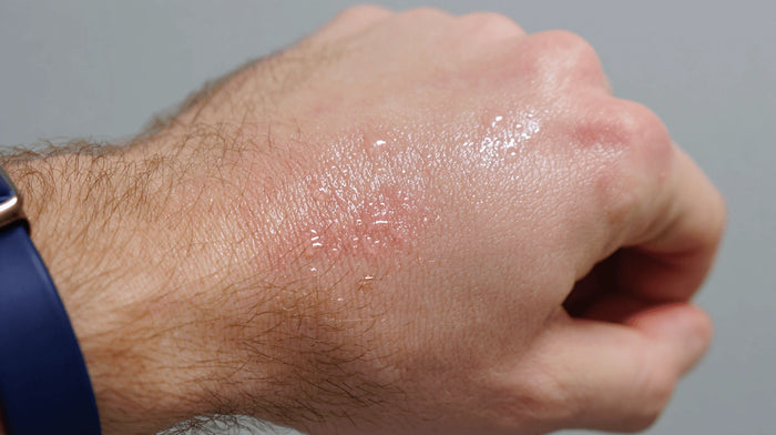 Softened skin breaks down faster under movement